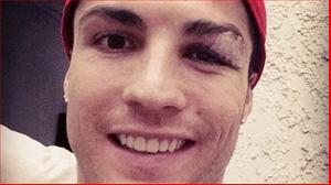 Mắt đau, Ronaldo vẫn cố tự sướng trên Facebook