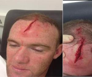 Rooney khoe ảnh chấn thương ghê rợn