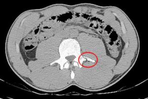 Neymar có một vết gãy xương rất lớn ở phần lưng