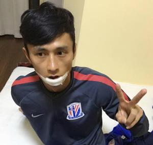 Chấn thương nặng vì bị... đồng đội ngả bàn đèn trúng mặt