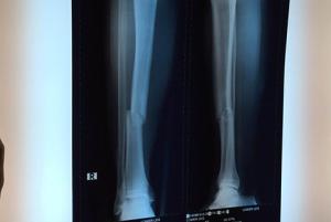 Tiết lộ: Osmar gãy chân vì sút trượt bóng