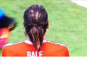 Gareth Bale đang mắc chứng hói đầu nặng