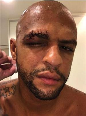 Thùng rác vàng một thời của Serie A dính chấn thương kinh dị