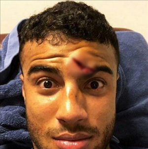 Sao Barca dính chấn thương rùng rợn