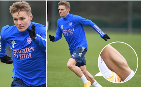NHM Arsenal phát cuồng với bắp chân của Martin Odegaard