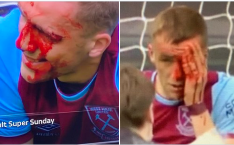 Sao West Ham bê bết máu sau pha va chạm kinh hoàng