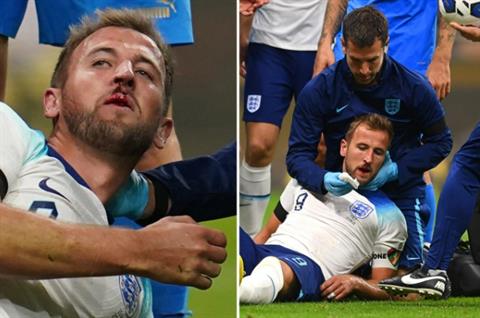 Harry Kane bê bết máu ở trận đấu với Italia