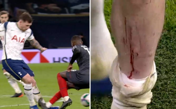 Hojbjerg báo tin vui sau chấn thương rợn người hình ảnh