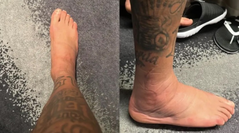 Cổ chân Neymar sưng to hơn lúc mới gặp chấn thương 1 Cổ chân Neymar sưng to hơn lúc mới gặp chấn thương 1