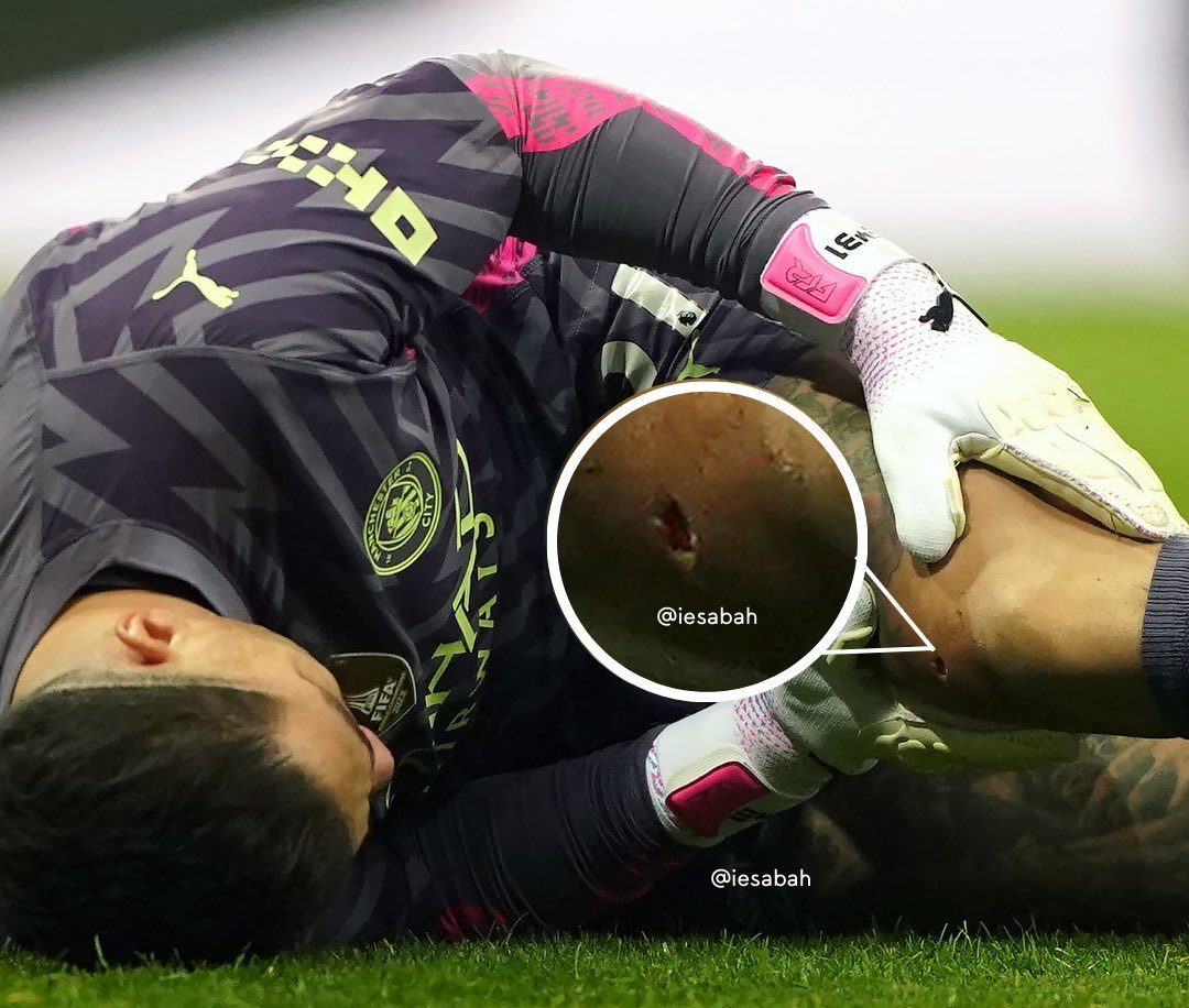 Cận cảnh chấn thương ghê rợn của thủ môn Ederson trước Newcastle 1