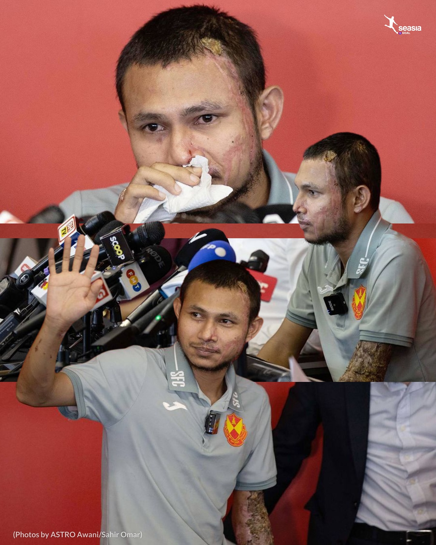 Tình trạng của tuyển thủ Malaysia sau hơn 1 tháng bị tạt axit 1 Tình trạng của tuyển thủ Malaysia sau hơn 1 tháng bị tạt axit 1