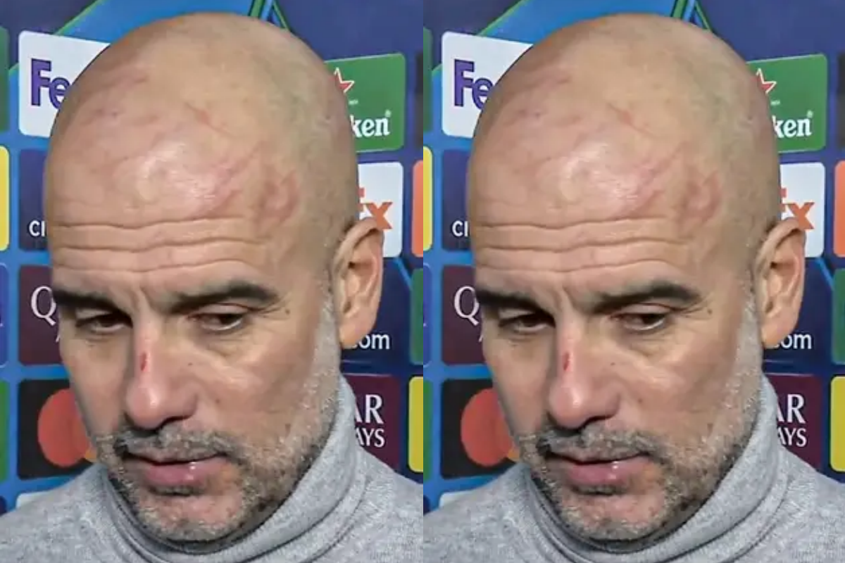 Khuôn mặt trầy xước của Pep Guardiola Khuon mat tray xuoc cua Pep Guardiola