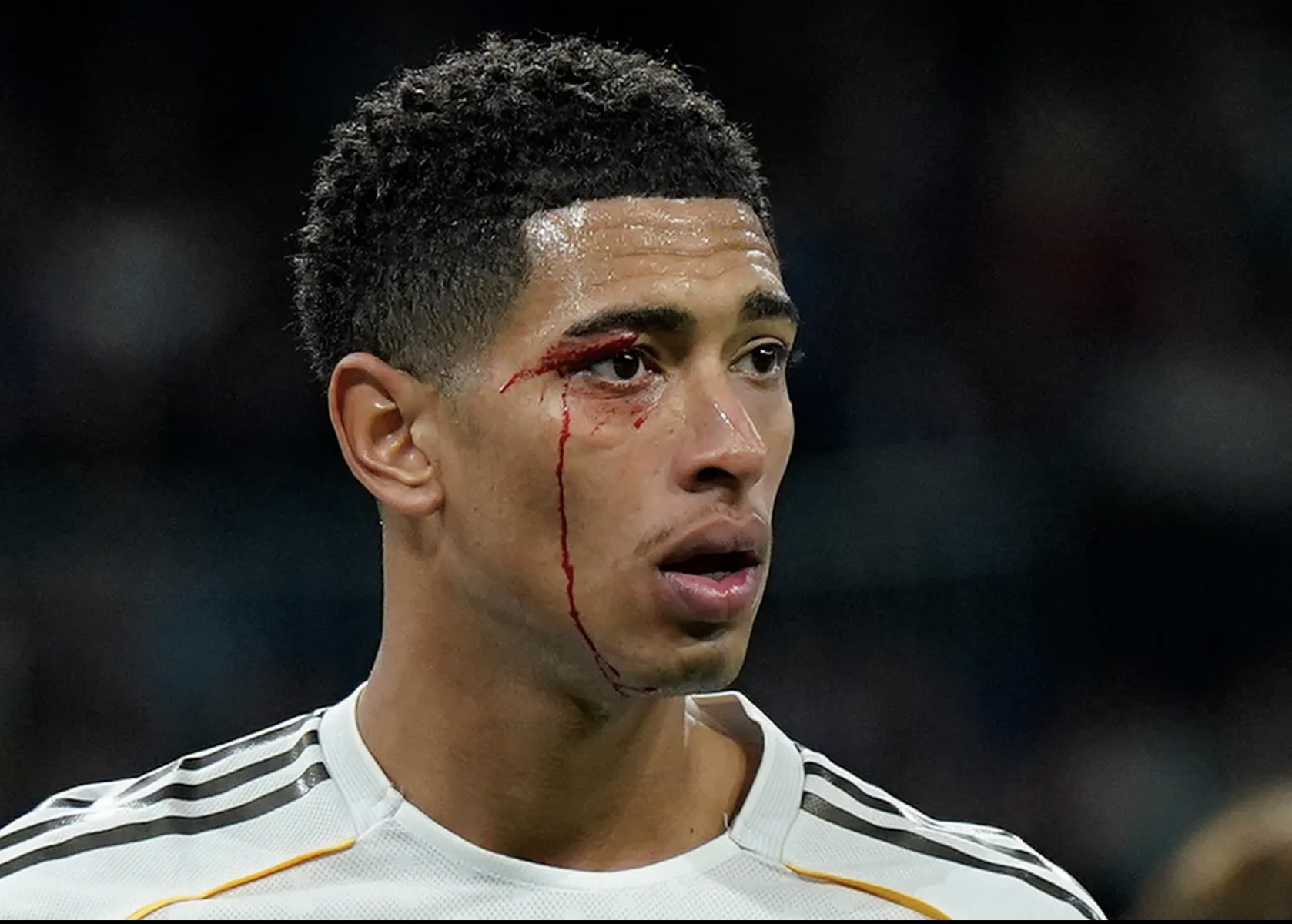 Jude Bellingham đổ máu trong ngày Real Madrid thảm bại 1 Jude Bellingham đổ máu trong ngày Real Madrid thảm bại 1