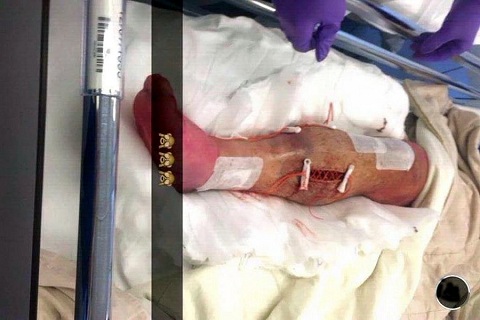 Nhói lòng với hình ảnh chân Luke Shaw siêu biến dạng sau phẫu thuật