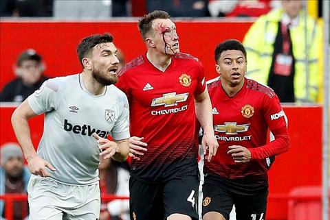 Phil Jones đổ máu trong trận thắng West Ham hình ảnh