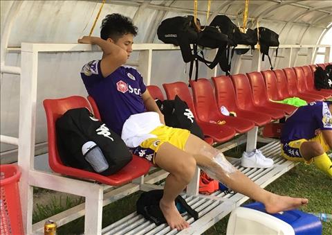 Đình Trọng có 90% cơ hội chữa lành chấn thương nhưng sẽ phải chờ rất lâu