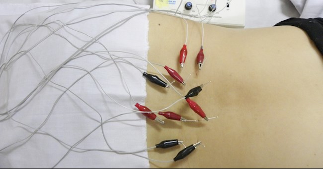 Châm cứu điều trị thoát vị đĩa đệm tại Bệnh viện Châm cứu Trung ương - Ảnh: BV Châm cứu TW