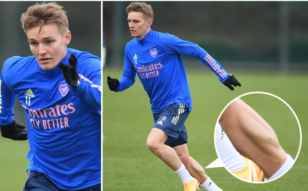 NHM Arsenal phát cuồng với bắp chân của tiền vệ Martin Odegaard hình ảnh