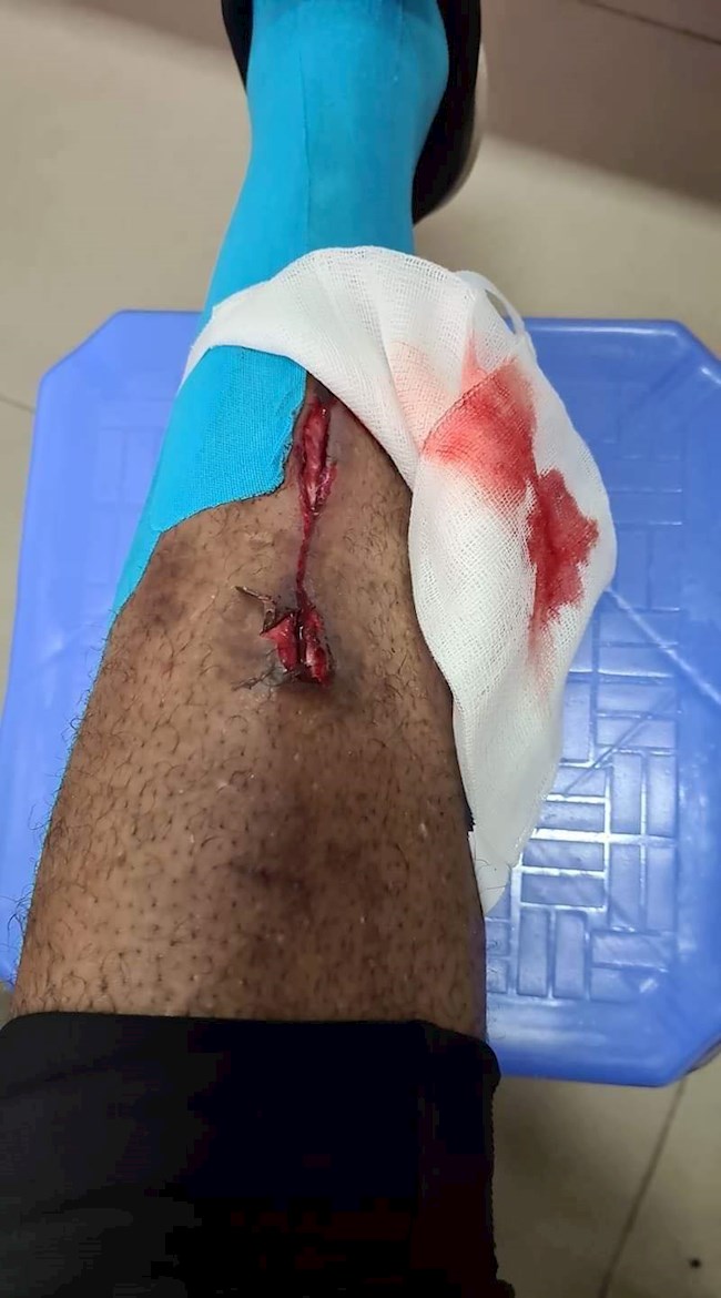Ngoại binh Hải Phòng khâu 25 mũi sau chấn thương rùng rợn hình ảnh