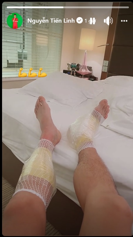Tiến Linh khoe đôi chân chườm đá trên facebook