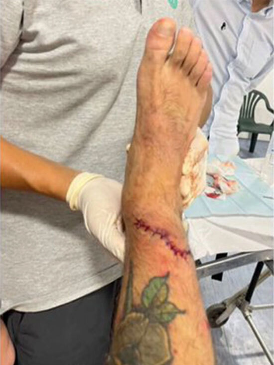 Tiền vệ Aleix Vidal đã dính chấn thương kinh hoàng trong trận hòa 2-2 giữa Espanyol và Real Betis, nhiều người không dám nhìn vết rách ở chân của cầu thủ này. Tiền vệ Aleix Vidal đã dính chấn thương kinh hoàng trong trận hòa 2-2 giữa Espanyol và Real Betis, nhiều người không dám nhìn vết rách ở chân của cầu thủ này.