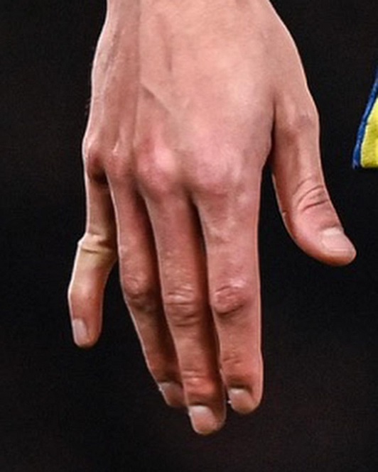 Kai Havertz bị gãy ngón tay