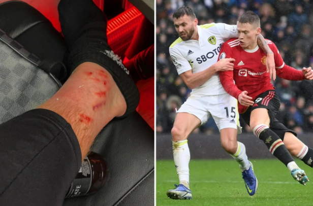 Scott McTominay đổ máu sau trận thắng Leeds United