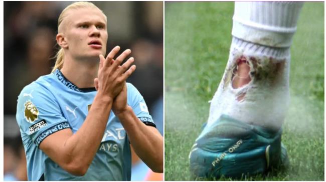 Pep noi ve chan thuong cua Erling Haaland 