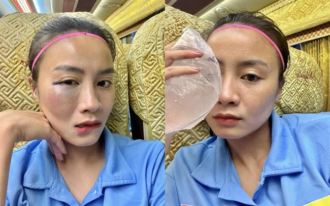 Hotgirl bóng đá nữ Hoàng Thị Loan bị sưng mặt