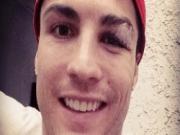 Mắt đau, Ronaldo vẫn cố "tự sướng" trên Facebook