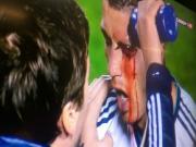 Xem ra Ronaldo vẫn còn .... may chán khi chỉ bị rách mắt!