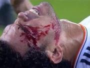 Pepe dính chấn thương nặng ở đầu