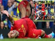 HLV Liverpool sôi máu vì Suarez bị chặt chém