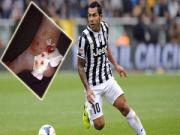 Tevez "khoe" mắt cá be bét sau derby Turin