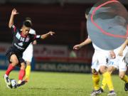 Cầu thủ Việt phải ghép gân vai vì pha bóng bạo lực