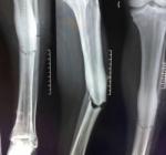 "Rợn người" bản chụp X-quang cái chân gãy của Demba Ba