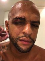 "Thùng rác vàng" một thời của Serie A dính chấn thương kinh dị