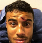 Sao Barca dính chấn thương rùng rợn