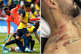 Khủng khiếp với chấn thương của Matheus Cunha