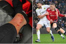Scott McTominay đổ máu sau trận thắng Leeds United